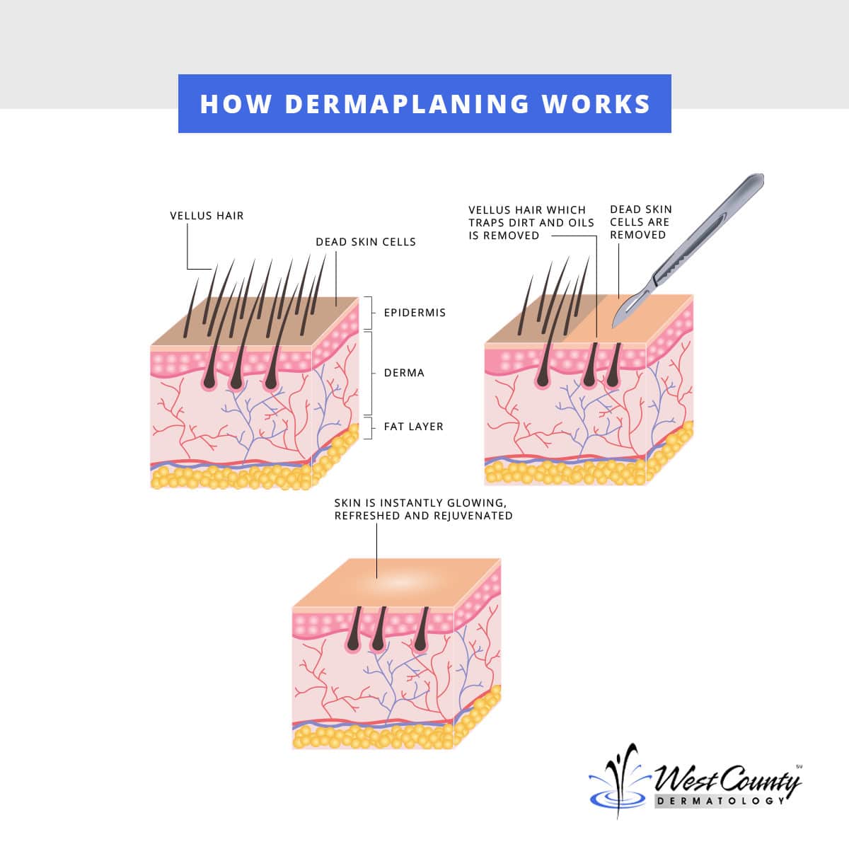 Using dermaplaning, the Chesterfield, MO-based West County Dermatology team clears away unwanted vellus hairs and dead skin cells. Using dermaplaning, the Chesterfield, MO-based West County Dermatology team clears away unwanted vellus hairs and dead skin cells.